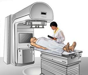 Radiation Therapy Image